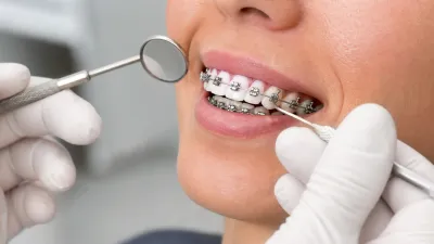 What Are Self-Ligating Braces?