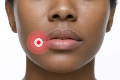Stomatitis: Causes, Symptoms, and How to Treat Mouth Inflammation
