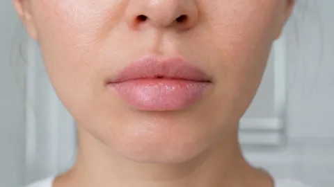 Granulomatous Cheilitis