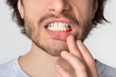 6 Causes of Itchy Gums - Treatments & Prevention