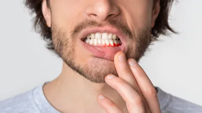 6 Causes of Itchy Gums - Treatments & Prevention