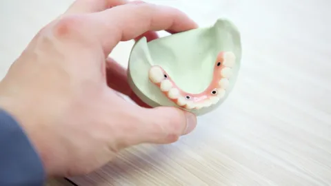 Should I Get All-on-4 Dental Implants?