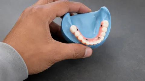 Should I Get All-on-4 Dental Implants?