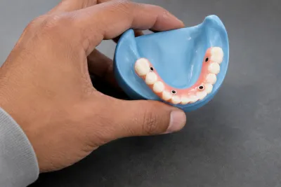 Should I Get All-on-4 Dental Implants?