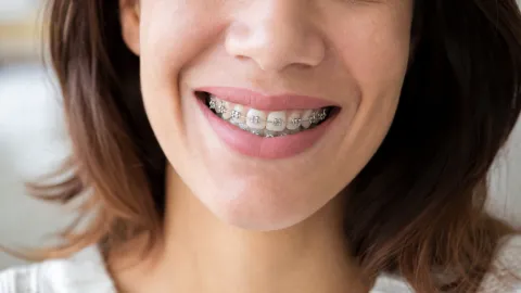 How Long Do Braces Take to Straighten Teeth?