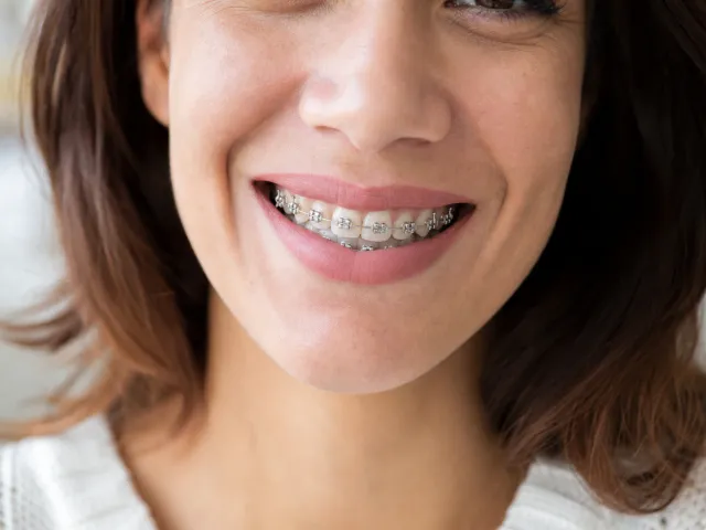 How Long Do Braces Take to Straighten Teeth?