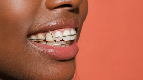 What Should You Do If You Lose Your Retainers?