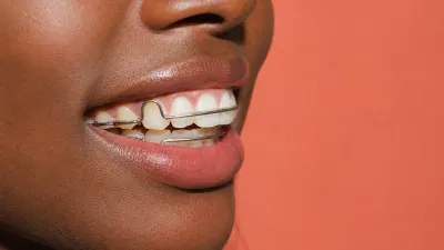 Should You Get a Permanent Retainer?