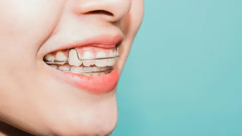 Should You Get a Permanent Retainer?