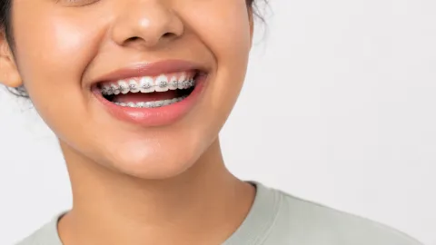 Clear Braces