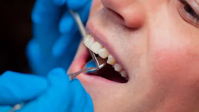 Calcium Buildup on Teeth