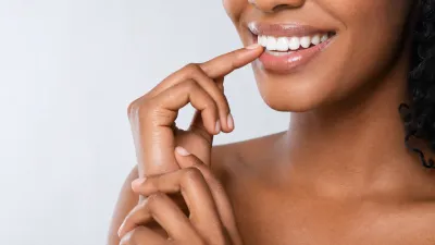 Instasmile Snap On Veneers Review