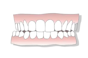 Crossbite malocclusion scaled 1