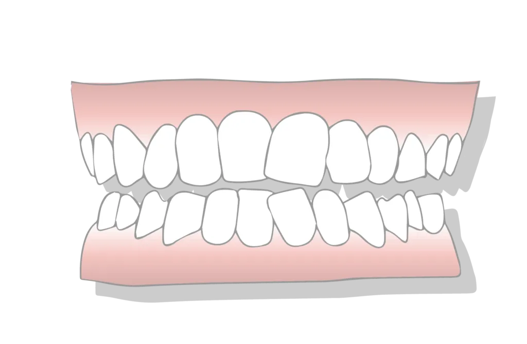 crowded teeth