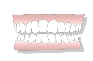 Crowded teeth