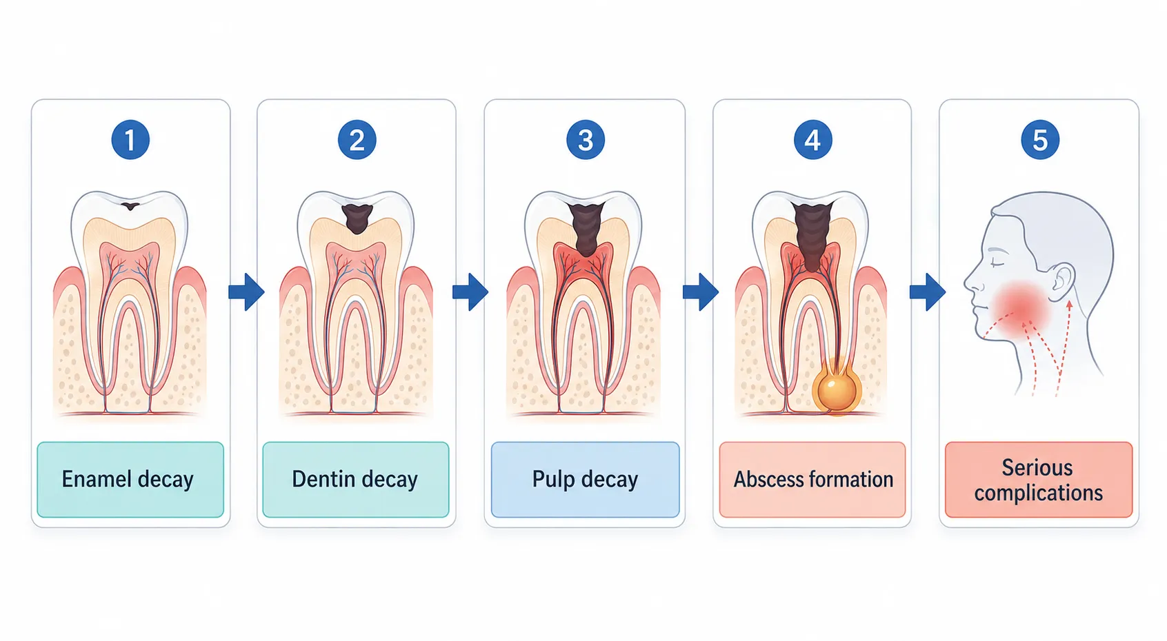 Dental abscess formation stages v1