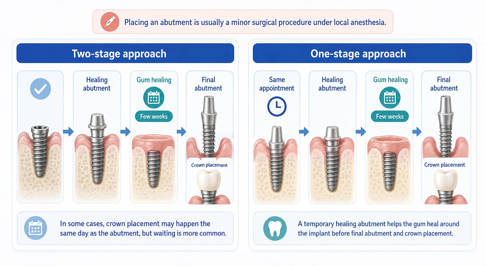 Dental abutment placement steps v1