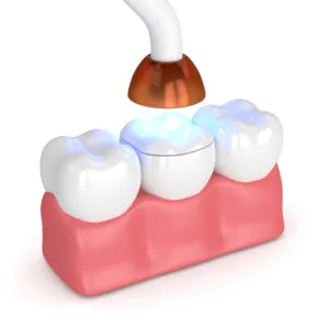 Dental bonding NewMouth