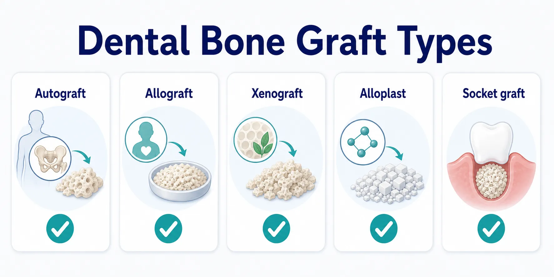 5 Types of Bone Grafts type comparison board covering Autograft, Allograft, Xenograft, Alloplast, Socket graft
