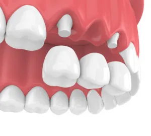 Dental bridge NewMouth