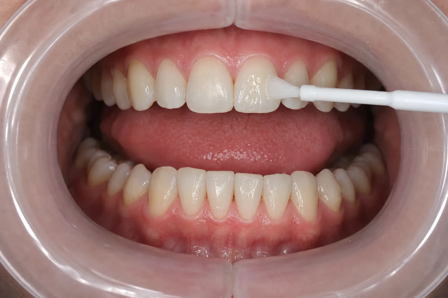 Dental flouride varnish being applied to a great set of teeth nm 1332