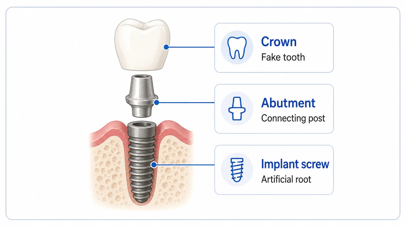 Dental implant structure showing crown, abutment, and implant screw