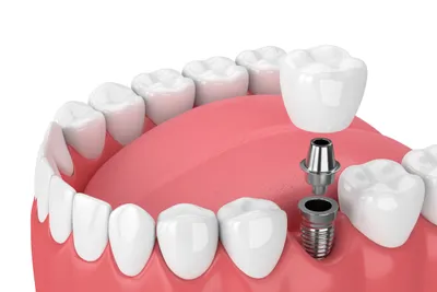 Types of Dental Implants & How They Work