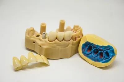 Stainless Steel Crowns: What They Are and How They Work