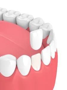 teeth with veneer