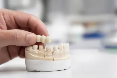 3 on 6 Dental Implants