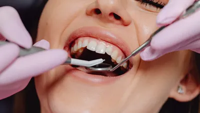 Fixing a Broken Tooth