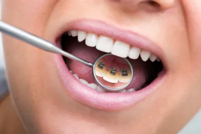 Lingual Braces: Pros, Cons, Costs and Comparisons