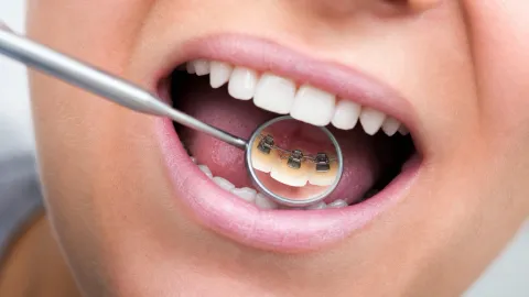 Lingual Braces: Pros, Cons, Costs and Comparisons