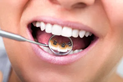 Lingual Braces: Pros, Cons, Costs and Comparisons