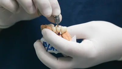 What Are Single Tooth Dentures?