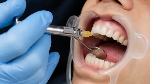 Dental Anesthesia