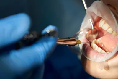 Dental Anesthesia