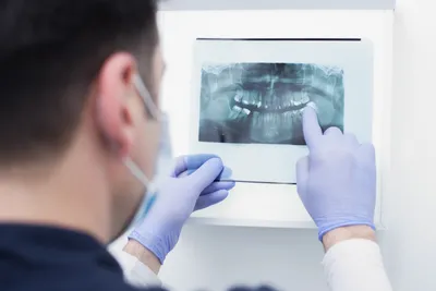 Teeth Fillings