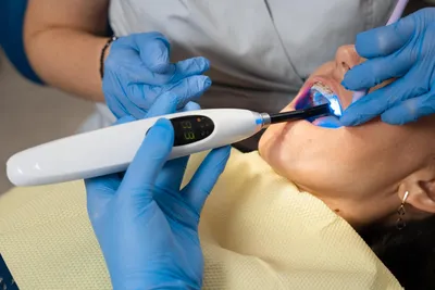 Dental Sealants: Cavity Prevention for Children & Teens
