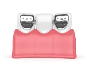 Dentistry restorative maryland bridge google doc 1