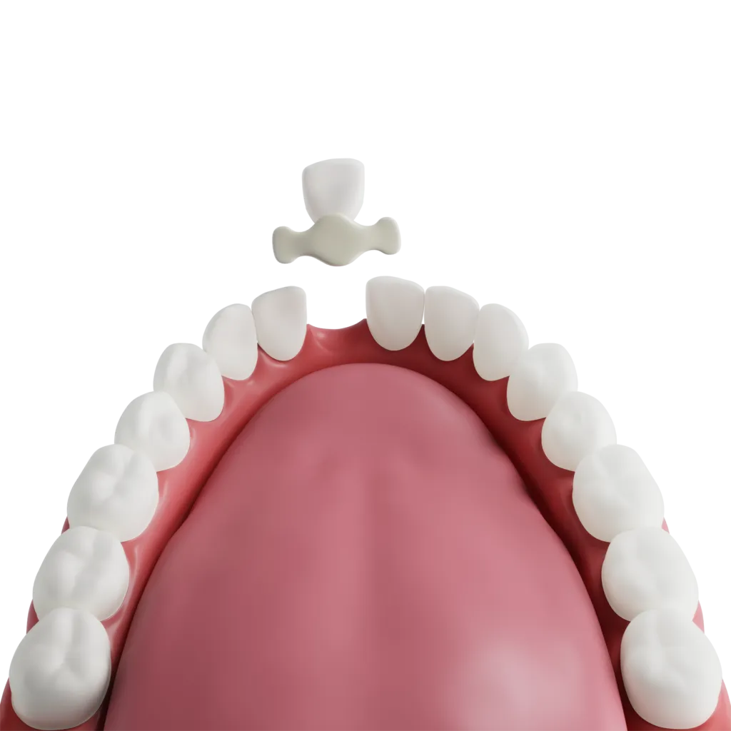 Dentistry restorative maryland bridge google doc 2