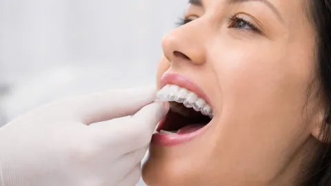 Invisalign Attachments (Buttons)