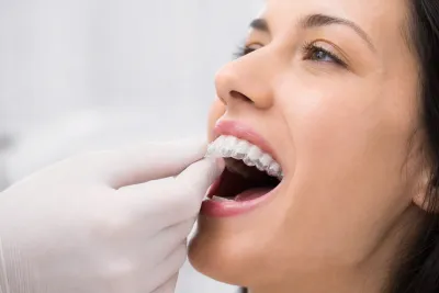 Invisalign Attachments (Buttons)