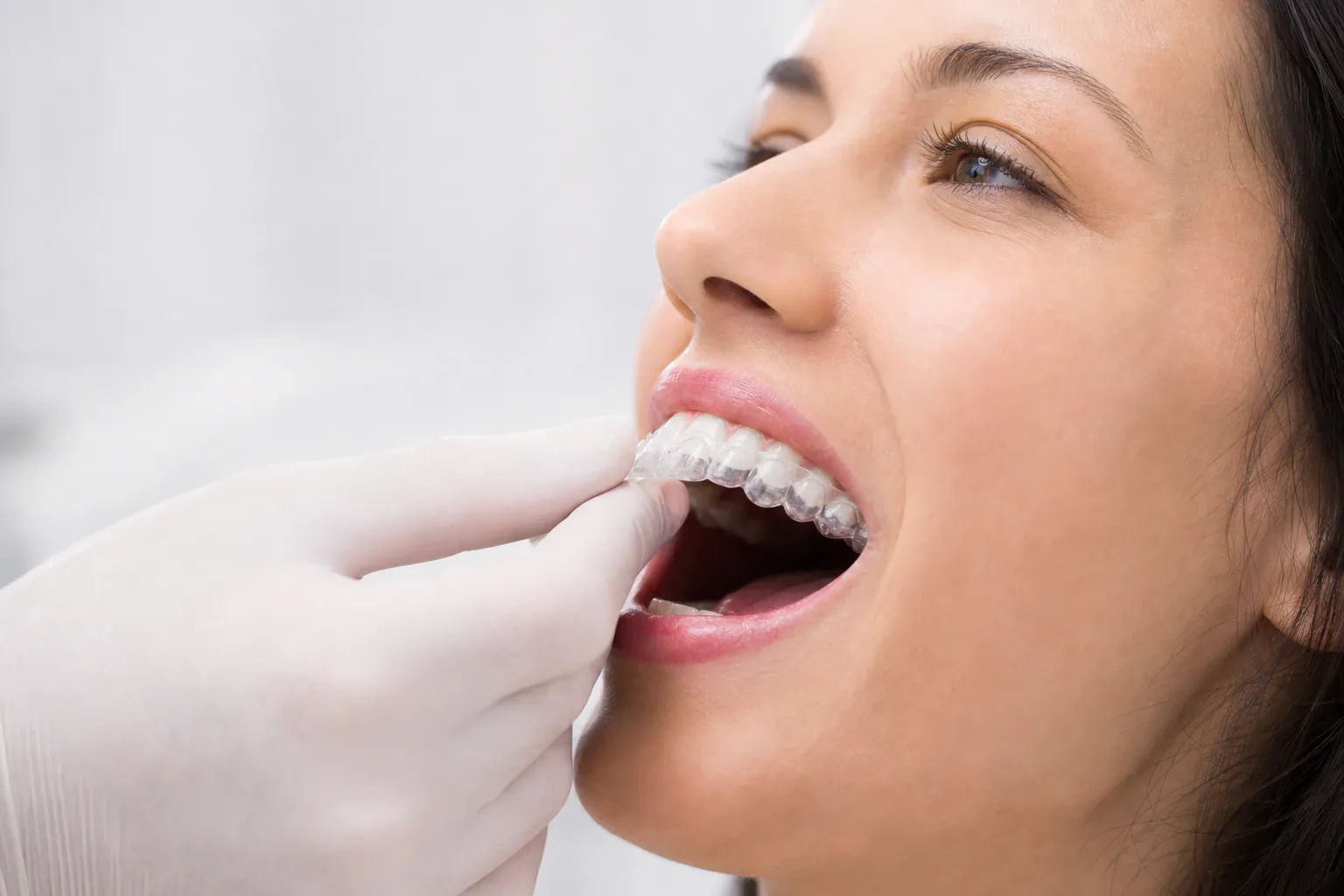Gloved hand putting clear aligners on patients teeth nm 0462