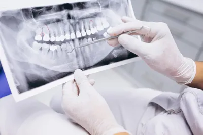 Dental X-rays: Types & Risks