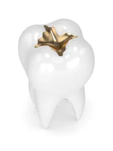 Gold cavity filling NewMouth