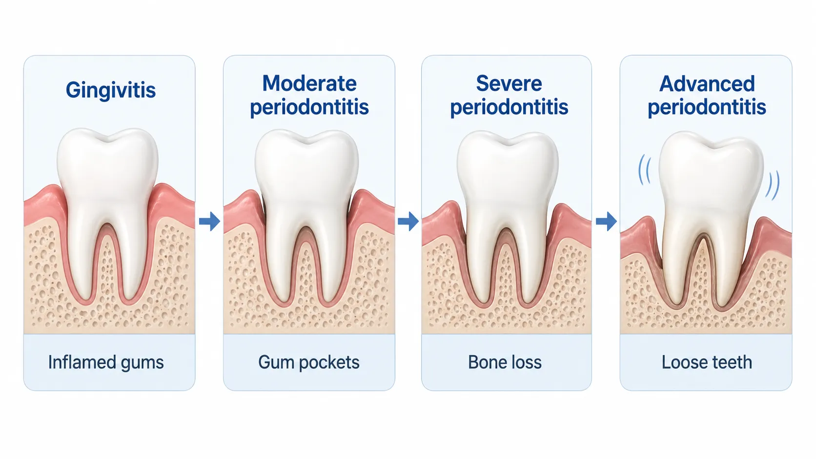 Gum disease stages board v1