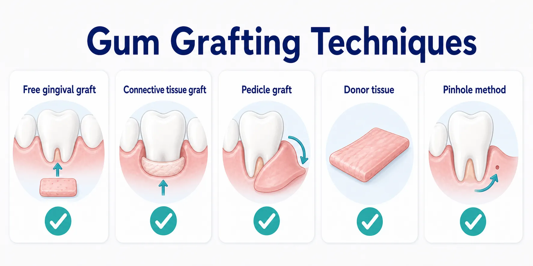 Different Gum Grafting Techniques technique comparison board covering Free gingival graft, Connective tissue graft, Pedicle graft, Donor tissue, Pinhole method