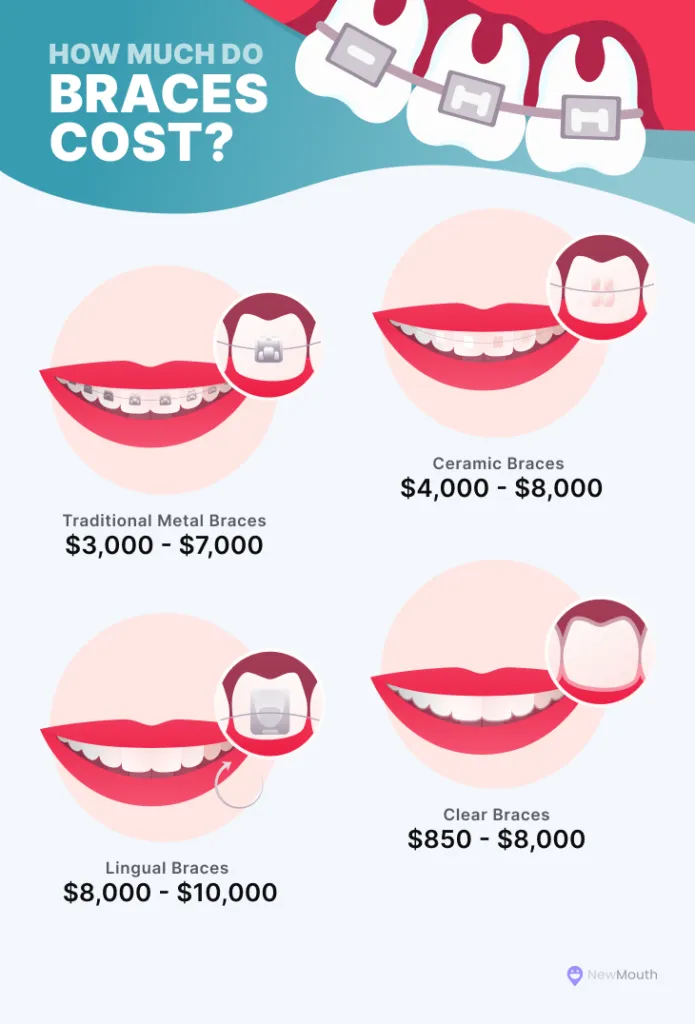 cost of traditional metal braces, ceramic braces, lingual braces, and clear braces