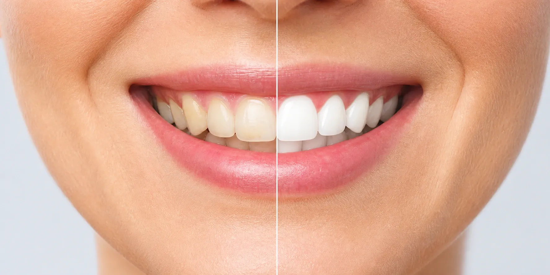 Illustrated comparison of a divided smile with healthy white teeth on nm 1284
